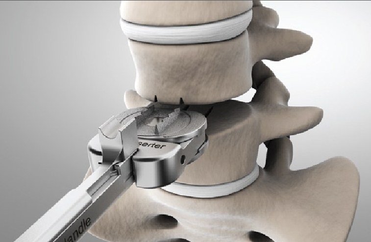 Cervical Disc Replacement