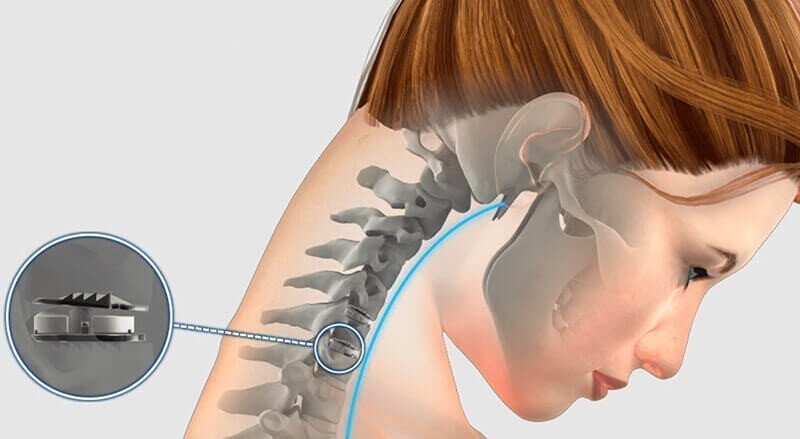 Cervical Disc Replacement