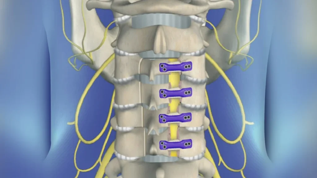 Lumbar Fusion