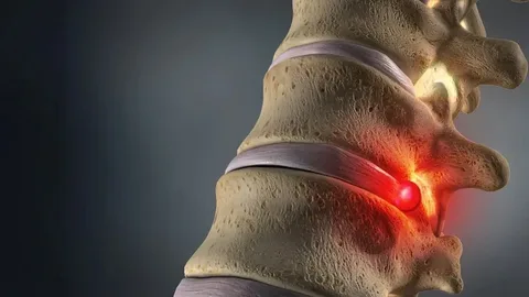 Herniated Disc Treatment