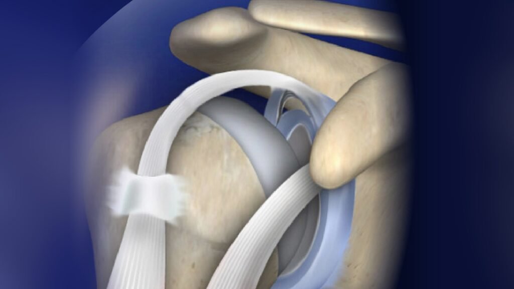 Labrum Tear Treatment